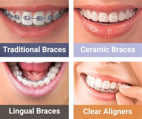 4 Best Invisible Braces and Teeth Aligners for Adults